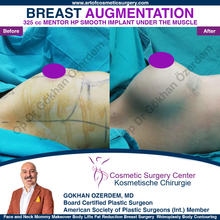 Breast Augmentation Before After
Breast Implants Turkey Antalya