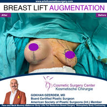 Breast Augmentation Before After
Breast Implants Turkey Antalya