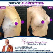 BREAST AUGMENTATION BREAST IMPLANT SURGERY ANTALYA TURKEY