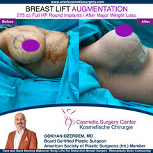 Breast Augmentation Before After
Breast Implants Turkey Antalya