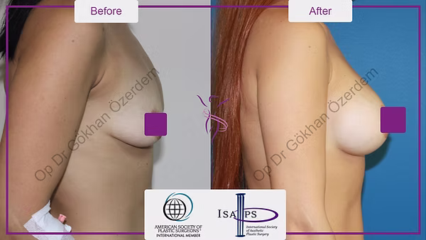 BREAST AUGMENTATION BREAST IMPLANT SURGERY ANTALYA TURKEY BEFORE AFTER