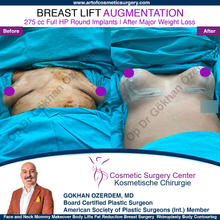 Breast Augmentation Before After
Breast Implants Turkey Antalya