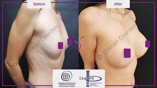 BREAST AUGMENTATION BREAST IMPLANT SURGERY ANTALYA TURKEY BEFORE AFTER