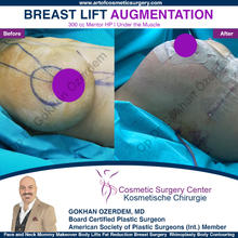 BREAST AUGMENTATION BREAST IMPLANT SURGERY ANTALYA TURKEY