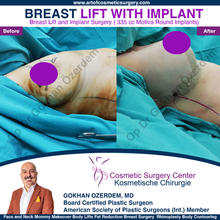 Breast Augmentation Before After
Breast Implants Turkey Antalya