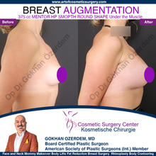 Breast Augmentation Before After
Breast Implants Turkey Antalya
