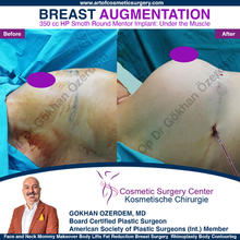 Breast Augmentation Before After
Breast Implants Turkey Antalya
