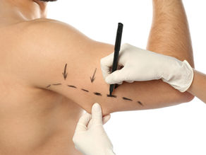 Arm Lift Brachioplasty in ANTALYA TURKEY