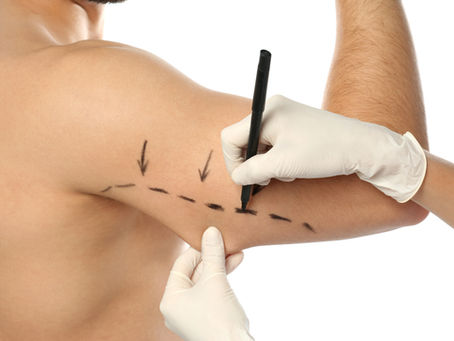 Arm Lift Brachioplasty in ANTALYA TURKEY