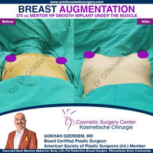 Breast Augmentation Before After
Breast Implants Turkey Antalya