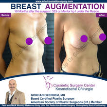 BREAST AUGMENTATION BREAST IMPLANT SURGERY ANTALYA TURKEY