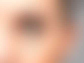 Lower and Upper Eyelid SurgeryBlepharoplasty in TURKEY ANTALYA