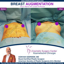 BREAST AUGMENTATION BREAST IMPLANT SURGERY ANTALYA TURKEY