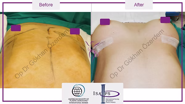 BREAST AUGMENTATION BREAST IMPLANT SURGERY ANTALYA TURKEY BEFORE AFTER